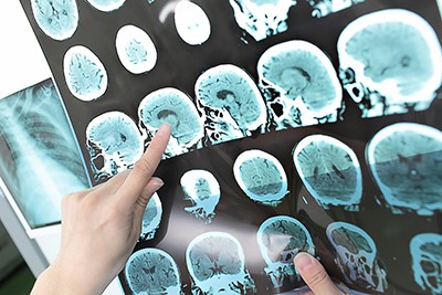 Doctors are Distinguishing Between PTSD and TBI Using Brain Scans