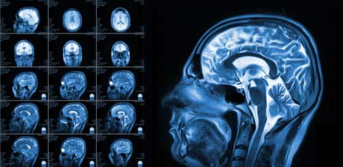 Profile X-Ray of a man's head | Northglenn Concussion Attorneys